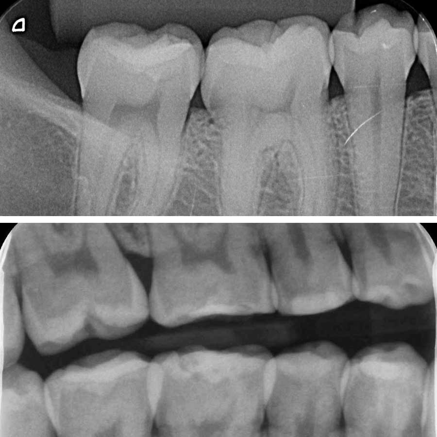 RAD_INTRAORAL